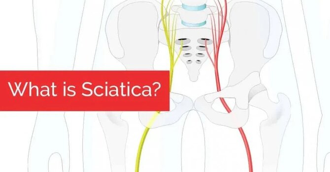 What is sciatica? image