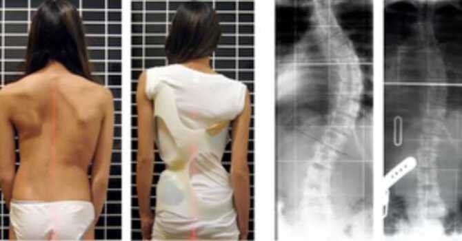 Scoliosis