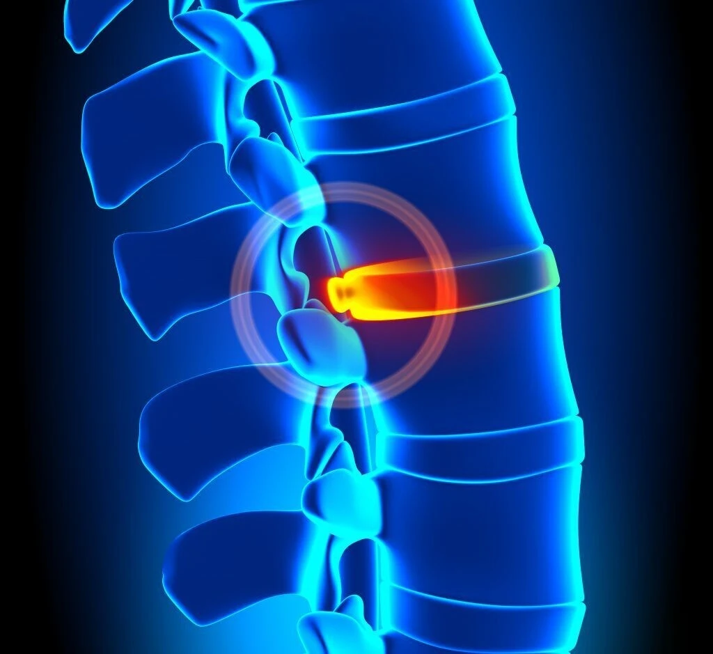 3D illustration of a spinal disc problem treated with chiropractic care - Greenlight Chiropractic & Wellness Lab