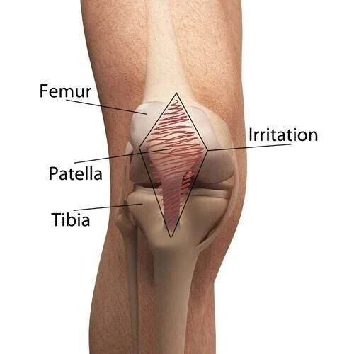Close-up of a knee illustrating patellofemoral pain syndrome - Greenlight Chiropractic & Wellness Lab